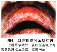 红色增殖性病变 词条正文口腔红斑发病年龄以41～50岁发病最高,发病