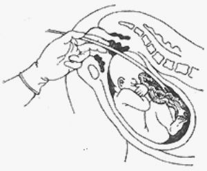 脐带还纳术有多种方法,常用方法是产妇取头低臀高位,用一加大旁孔的