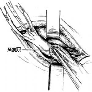1-1 拉开外环,分开提睾肌,显露精索和疝囊(附图示切口)1-2分离并切开