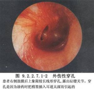 (1)慢性化脓性中耳炎所致的鼓膜紧张