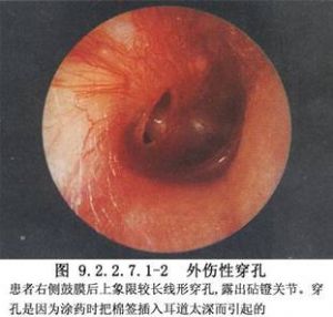 鼓膜成形术 词条正文 1,干耳 除鼓室无脓液外,还应在显微镜下观察鼓膜