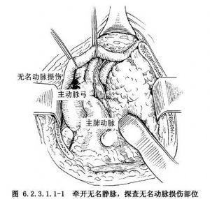 无名动脉损伤修复术