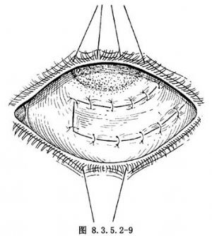广泛睑球粘连穹隆再造术