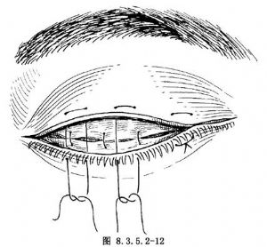 广泛睑球粘连穹隆再造术