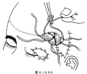 颞浅动脉综合组织瓣移植修复眼眶上眼睑畸形