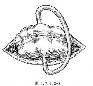 横结肠双腔造瘘术