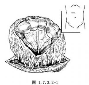 横结肠双腔造口术