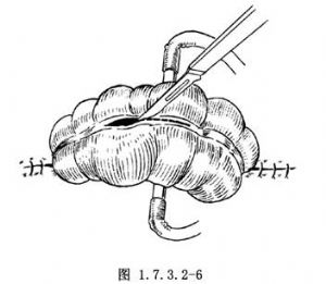 横结肠双腔造瘘术